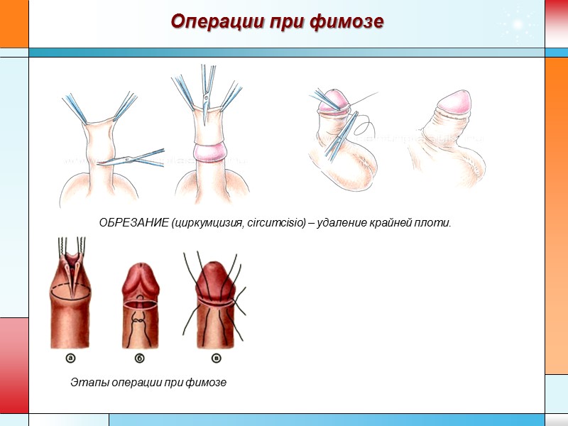 Операции при фимозе Этапы операции при фимозе ОБРЕЗАНИЕ (циркумцизия, circumcisio) – удаление крайней плоти.
